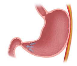 PyloromyotomyProcedure 1