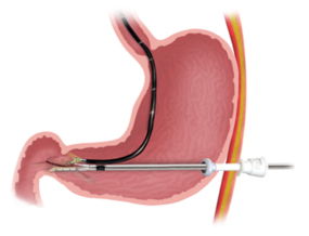 PyloromyotomyProcedure 1