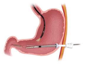 PyloromyotomyProcedure 1