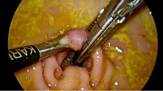 Pyloroplasty